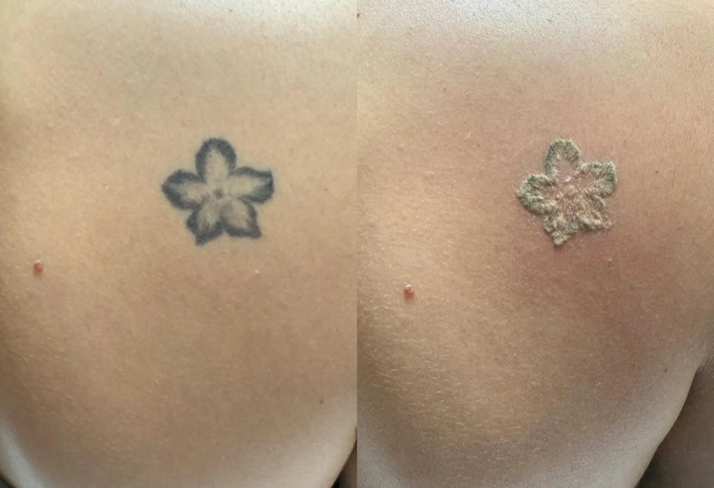 Hair Removal | Safe Tattoo Removal: Saline vs. Laser Options in Melbourne Hair Removal|Safe Tattoo Removal: Saline vs. Laser Options in Melbourne